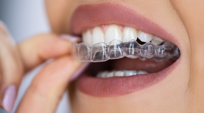 Clear Aligners: Where Comfort Meets Confidence